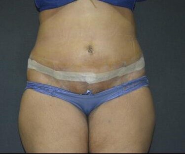 Абдоминопластика