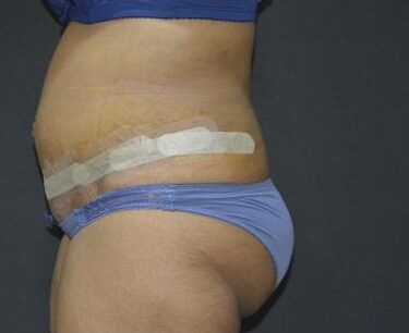 Липосакция