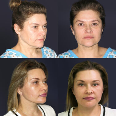 Подтяжка лица