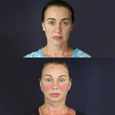 Подтяжка лица