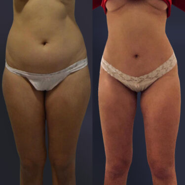 Липосакция