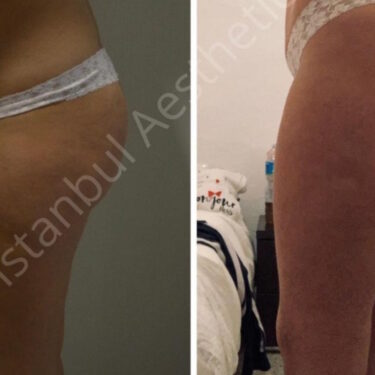 Липосакция