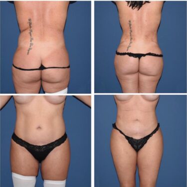 Липосакция