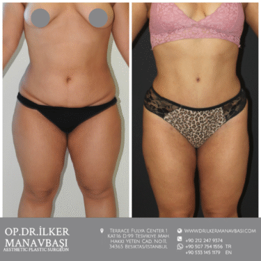 Liposuction