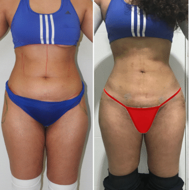 Liposuction