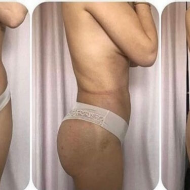 Липосакция