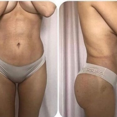 Liposuction