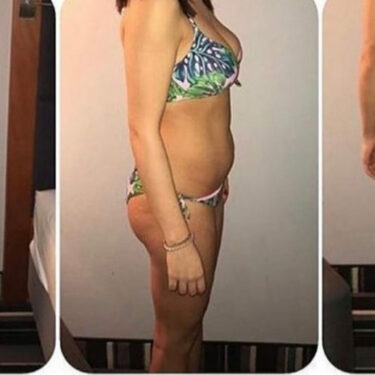 Липосакция