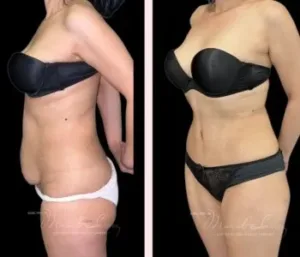 all-inclusive tummy tuck