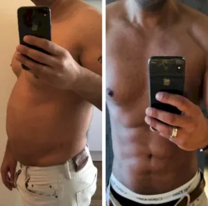 male tummy tuck