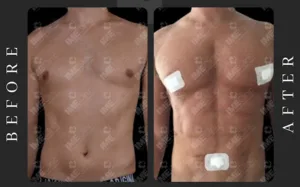 tummy tuck