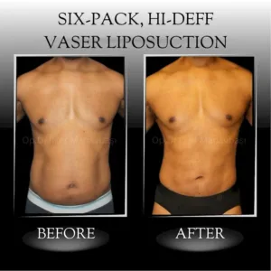 results of a tummy tuck