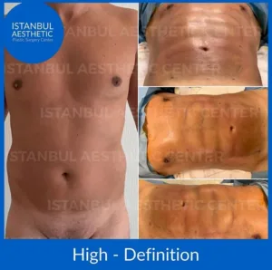 tummy tuck procedures