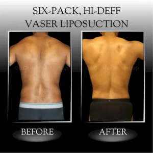 full tummy tuck