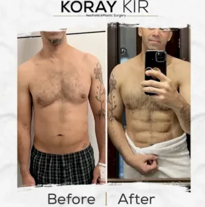 cost of a tummy tuck