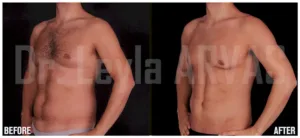 Six Pack Tummy Tuck