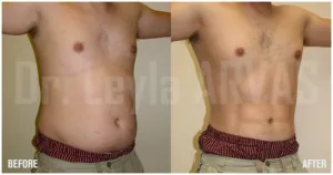 6 Pack Tummy Tuck