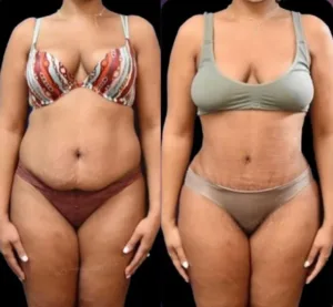 tummy tuck surgery in turkey