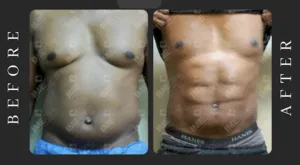 abdominoplasty with contouring