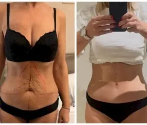 abdominal surgery