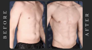 male tummy tuck