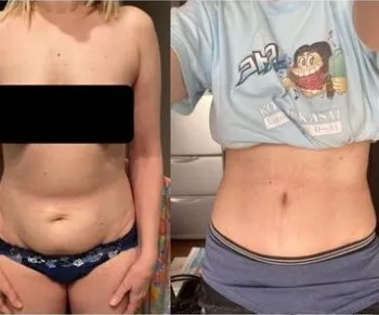 full tummy tuck
