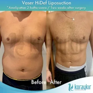 tummy tuck by Koray Kir