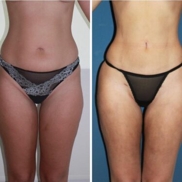 Липосакция