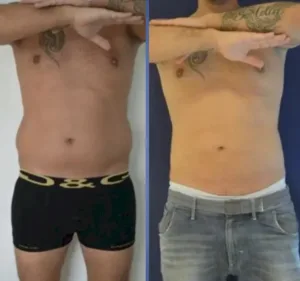 tummy tuck by Ergin Er