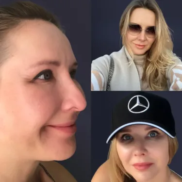 Ринопластика