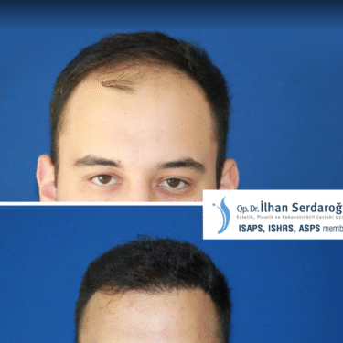 Пересадка волос