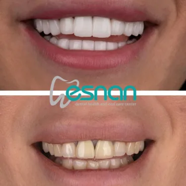 Blanchiment des dents
