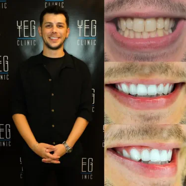 Dental Implants, Hollywood Smile