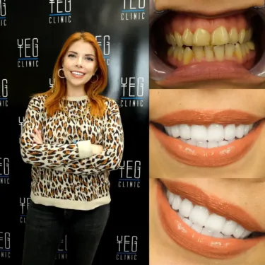Dental Implants, Hollywood Smile
