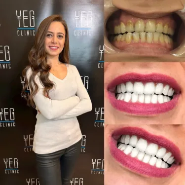Dental Implants, Hollywood Smile