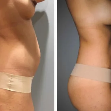 Liposuction