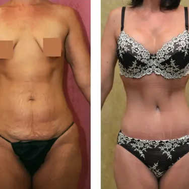 Липосакция