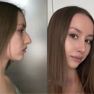 Rhinoplasty