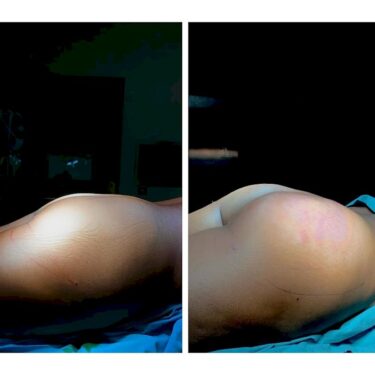  Brazilian Butt Lift (BBL)