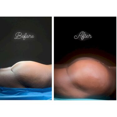  Brazilian Butt Lift (BBL)