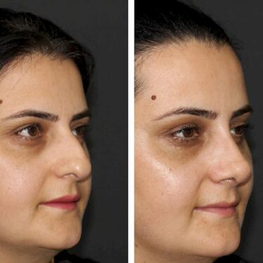 Rhinoplasty