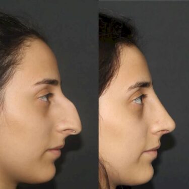 Rhinoplasty