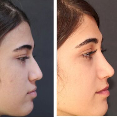 Rhinoplasty