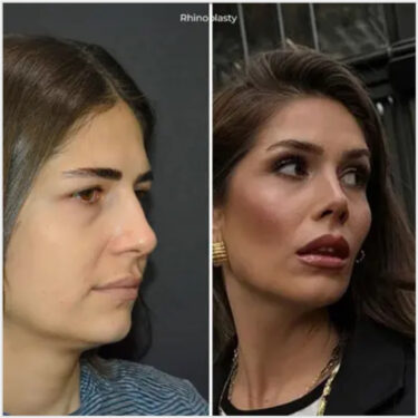 Ринопластика