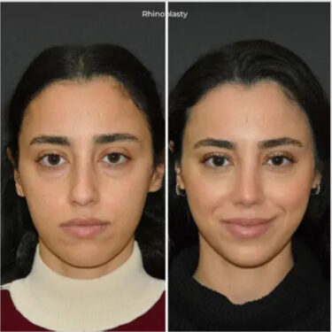 Ринопластика