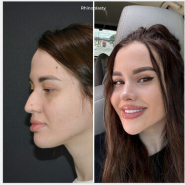 Ринопластика