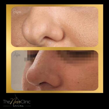 Rhinoplastie 