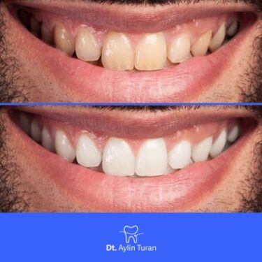 Отбеливание зубов