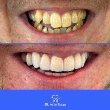 Отбеливание зубов