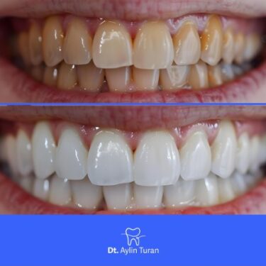 Отбеливание зубов